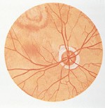 视网膜脱离治愈后的眼底