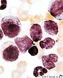 急性骨髓性白血病病人血液的显微照片
