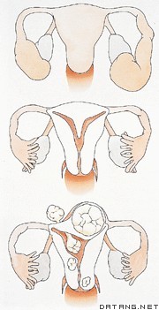 女性造成不孕的原因：上：输卵管炎症 中：子宫畸形（宫内有膈） 下：子宫肿瘤