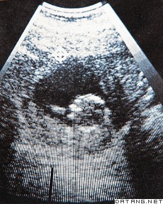 超声诊断，可对孕妇进行没有X射线危险的检查，图中可见胎儿的头部