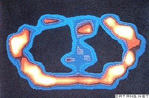 磁共振成像的胸部显影片