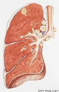 浸润性肺结核